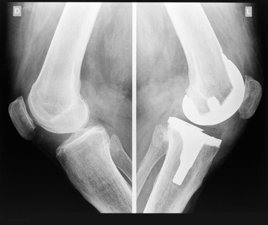 Artroplastia do joelho: Atividade física e implante ortopédico